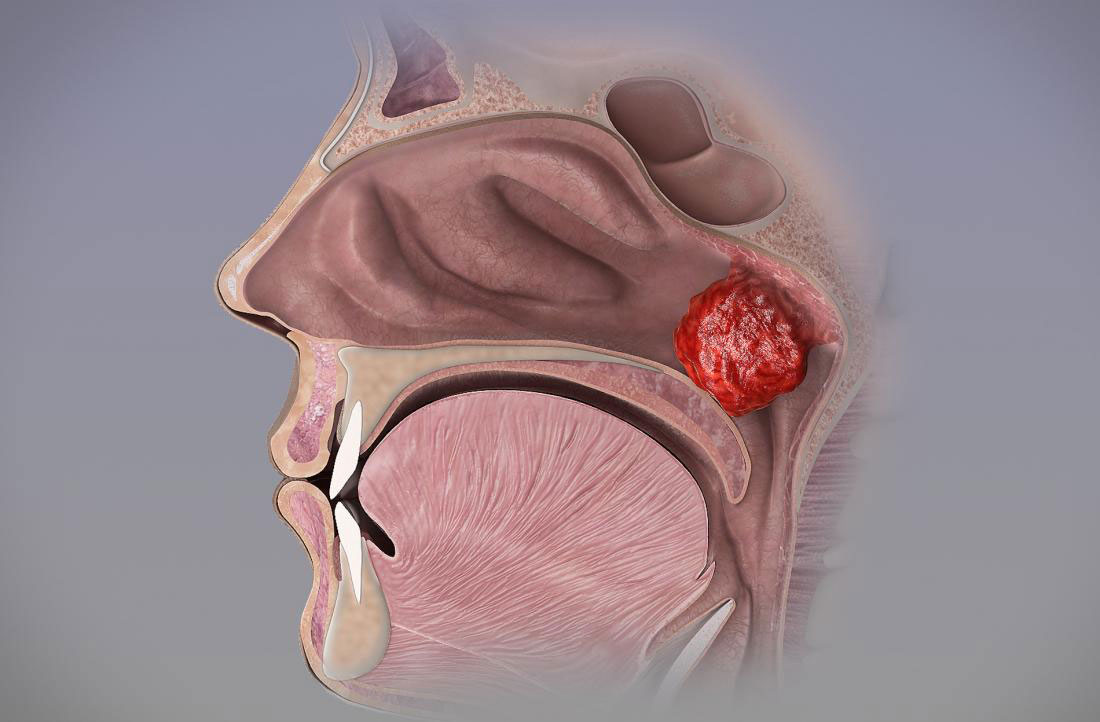 Adenoids